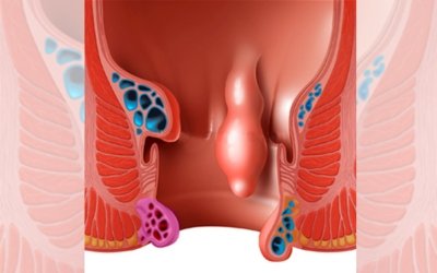 Anal Polyp Treatment